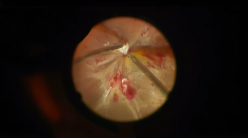 Chirurgia su retinopatia diabetica con R-evolution - Dott. Tommaso Rossi