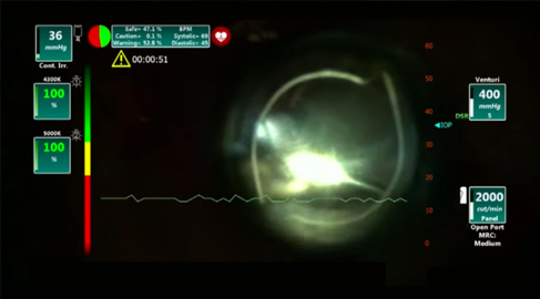 Vitrectomia 25G con sistema MOPP  - R-evolution CR – Dott. Tommaso Rossi – Floretina 2015
