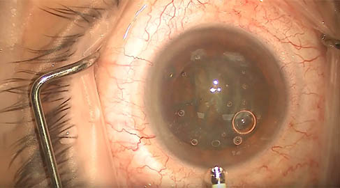 Chirurgia della cataratta con impianto della IOL Multifocale FineVision by PhysIOL